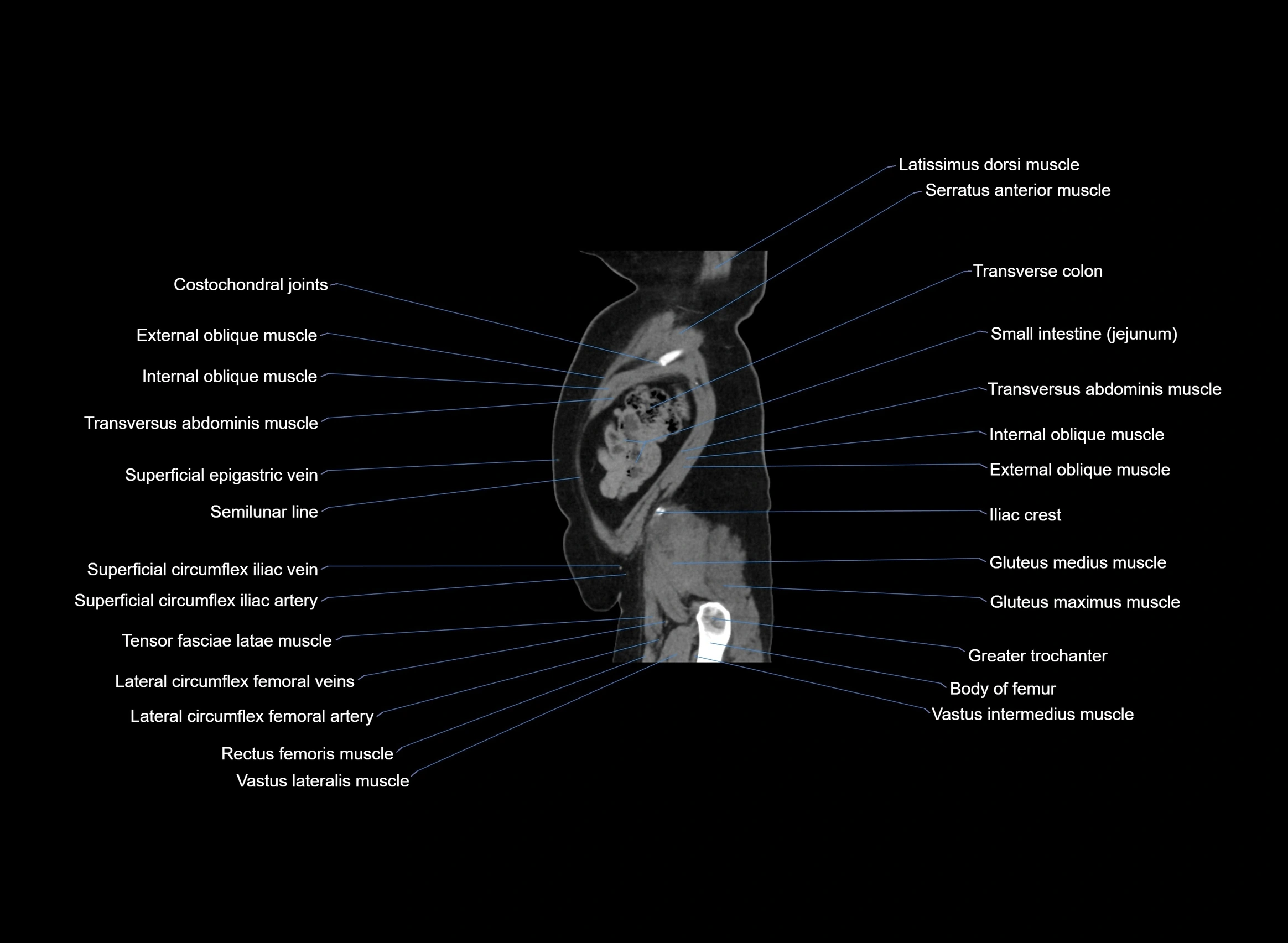 CT Abdomen sagittal cross sectional anatomy labelled radiology image -00013.webp